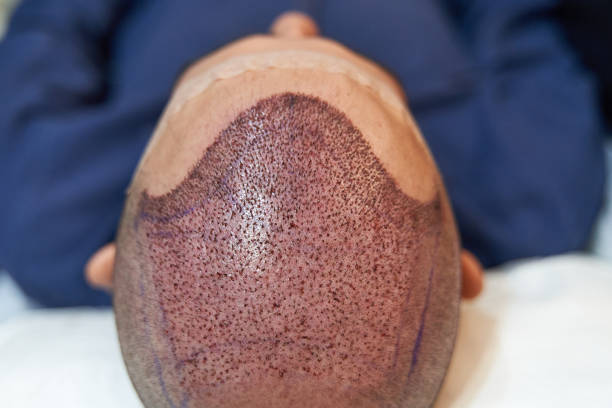 زراعة الشعر في أبوظبي