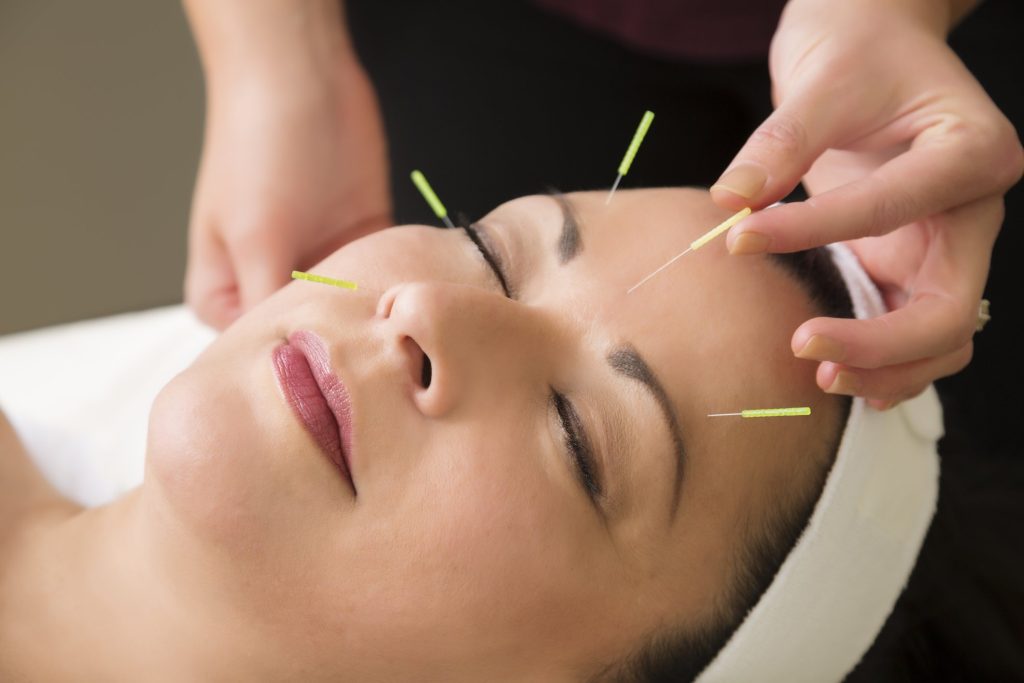 facial acupuncture near me