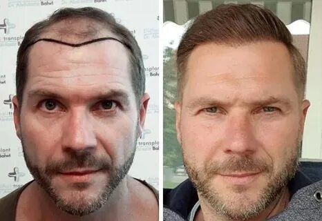 hair transplant in Islamabad