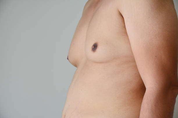 Can Gynecomastia Surgery Restore Your Confidence