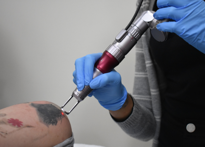 Does Laser Tattoo Removal Leave the Skin Smooth