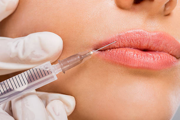 Does Lip Fillers Enhance Lip Shape