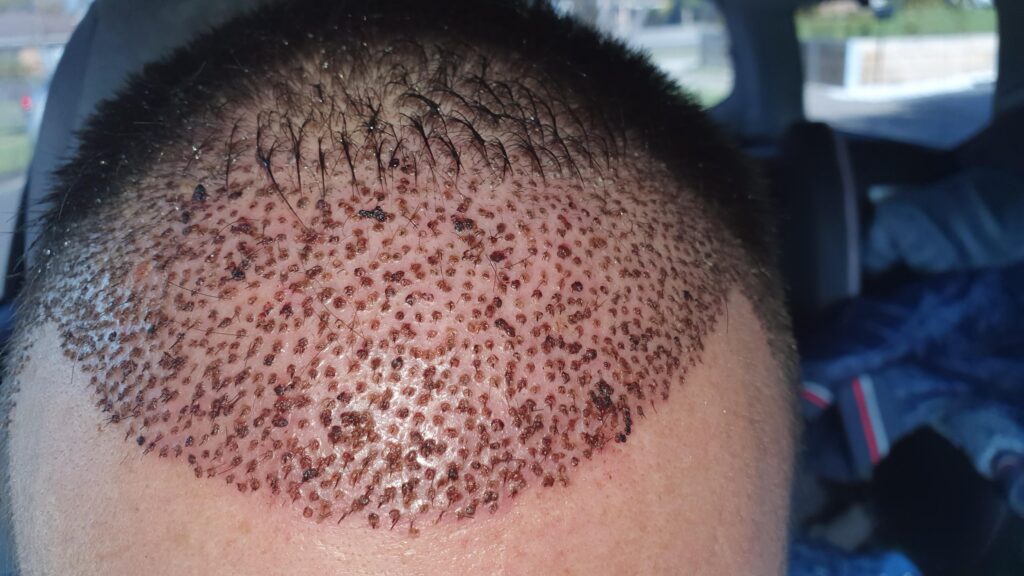 FUE Hair Transplant Modern Hair Restoration Techniques