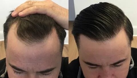 hair transplant in Islamabad