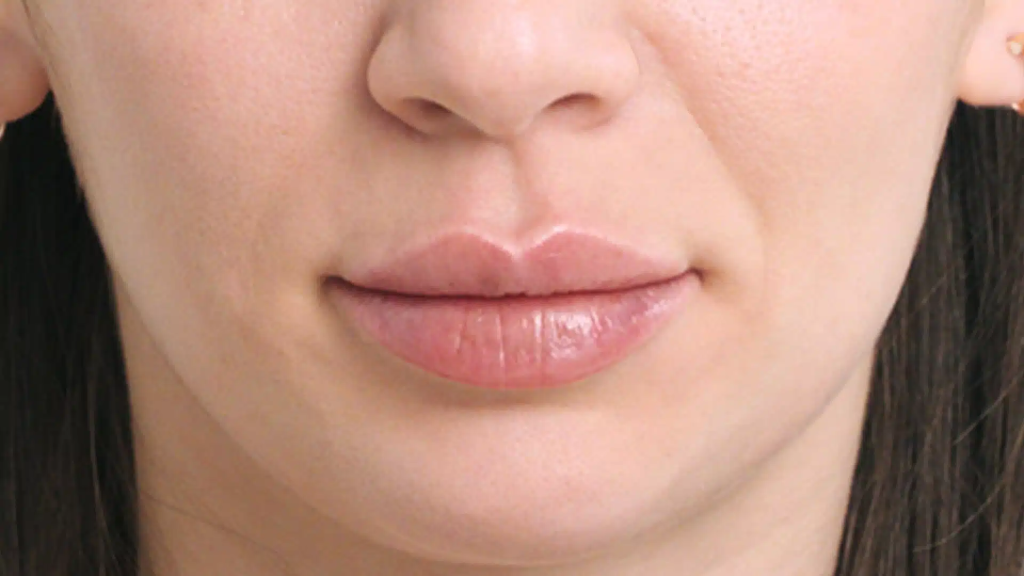 How Lip Fillers Boost Confidence Instantly