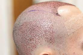 How to Get Accurate Hair Transplant Cost Estimates?