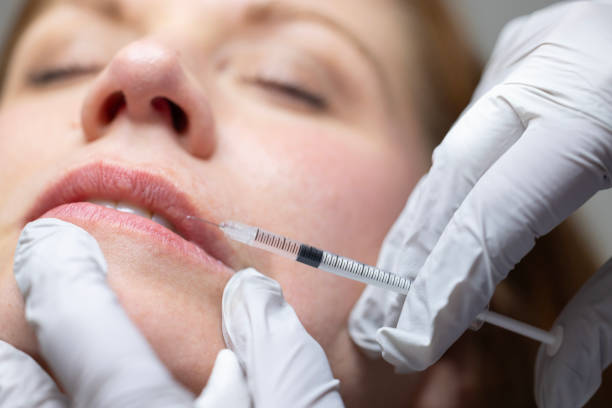 Is It Worth Getting Lip Fillers