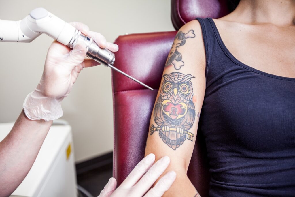 Is Laser Tattoo Removal Better Than Other Methods