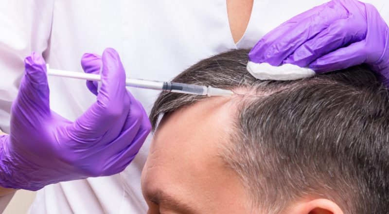 Is PRP Hair Treatment Good for Receding Hairlines