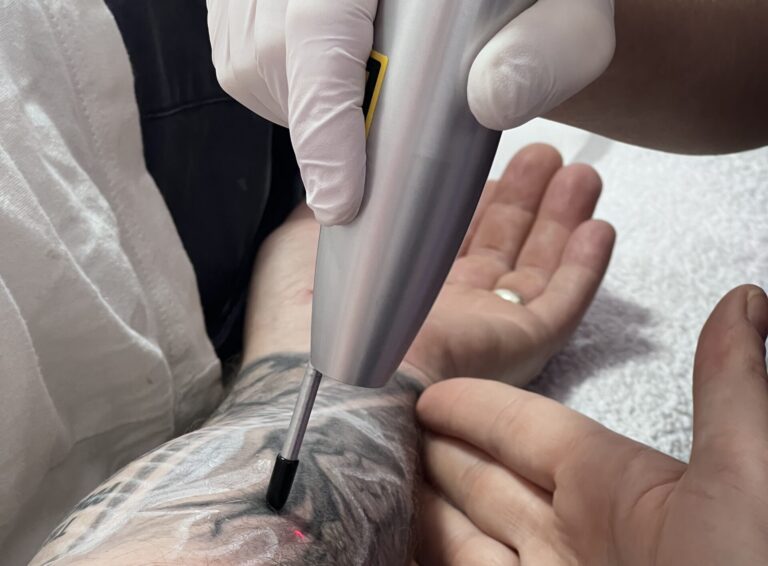 Laser Tattoo Removal Transform Your Skin Confidently