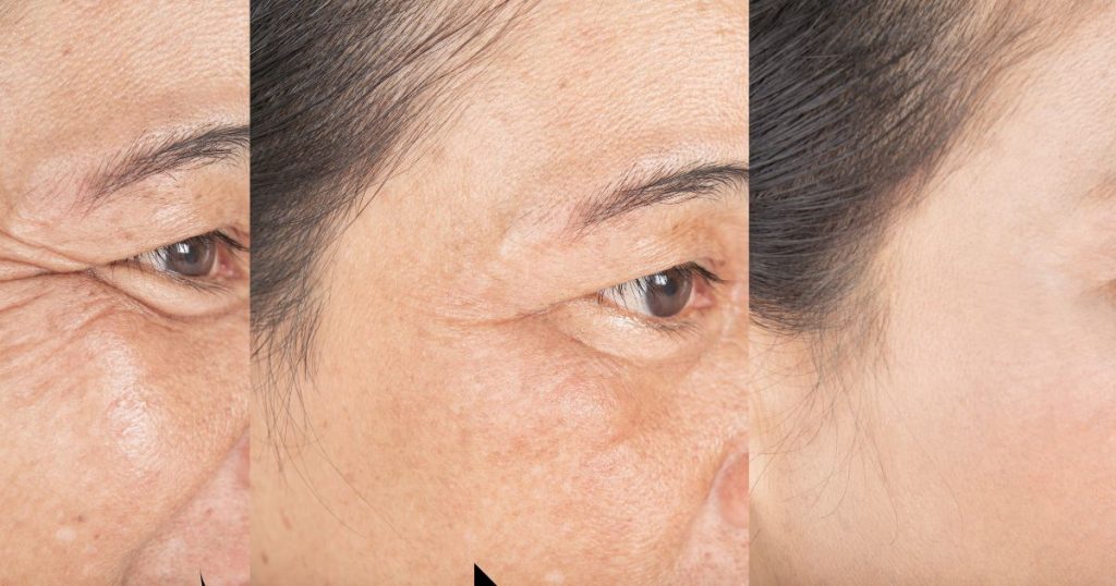Is 20 units of Botox enough for forehead lines?