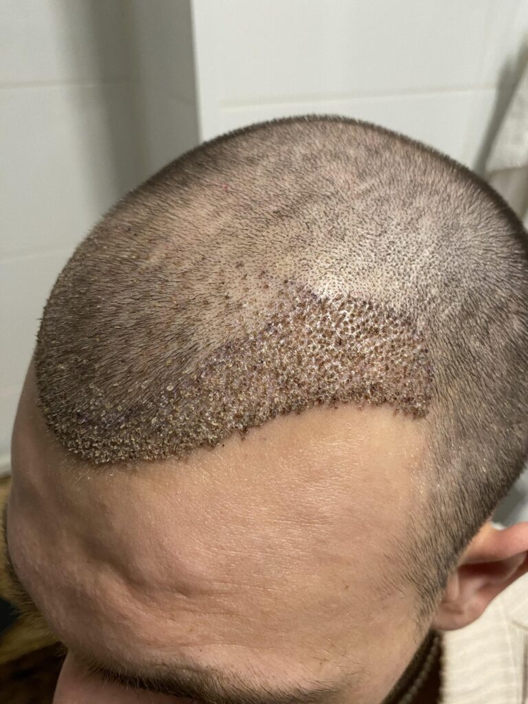What Are the Benefits of FUE Hair Transplant