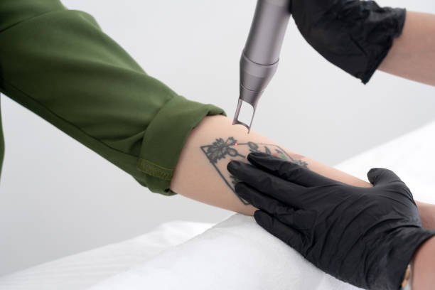 What Happens During Laser Tattoo Removal