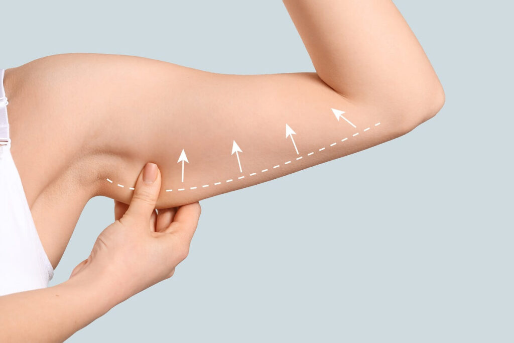 What Plastic Surgeon Technique Improves Arm Lift Surgery?